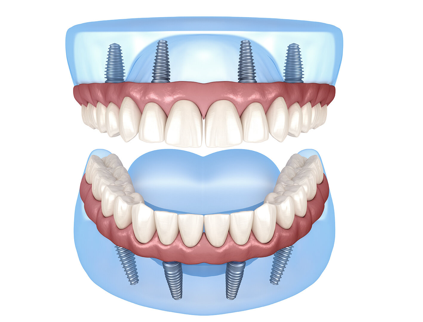 Dental Implants near you in Lake Orion, Michigan