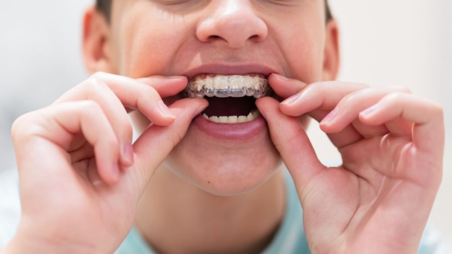 Invisalign and Invisalign Teen