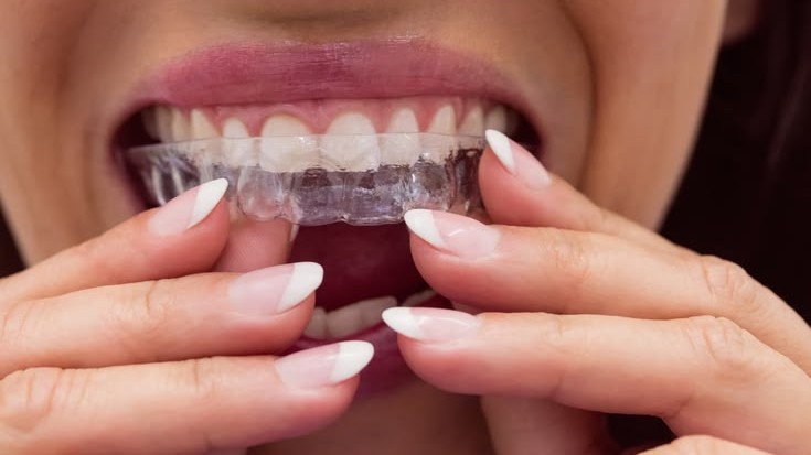 Invisalign in Lake Orion