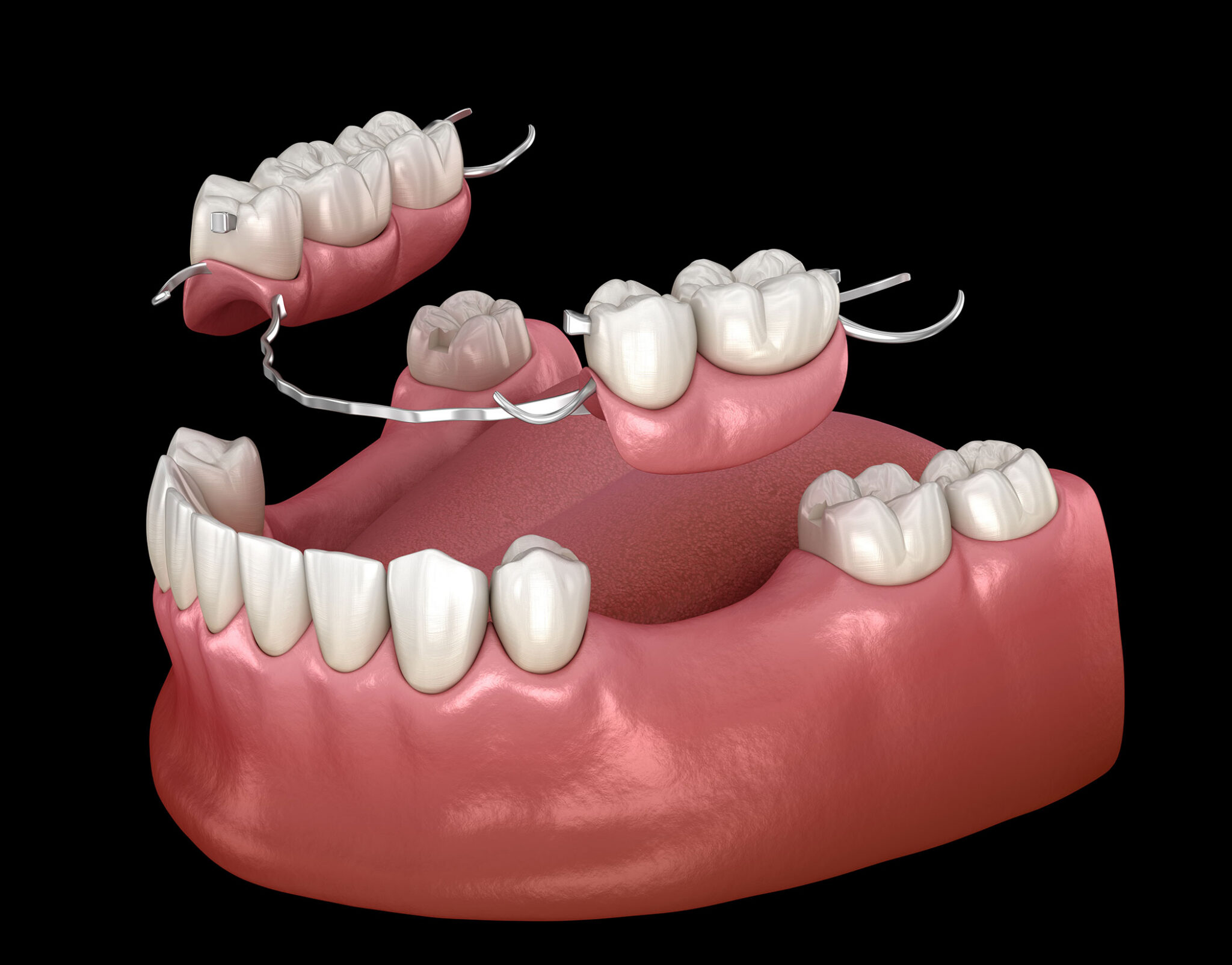 Partial Dentures Lake Orion